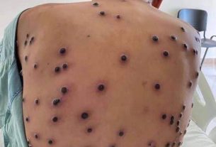 Malaysia Tingkatkan Pengawasan dan Kesedaran Mpox Selepas Amaran Tertinggi WHO