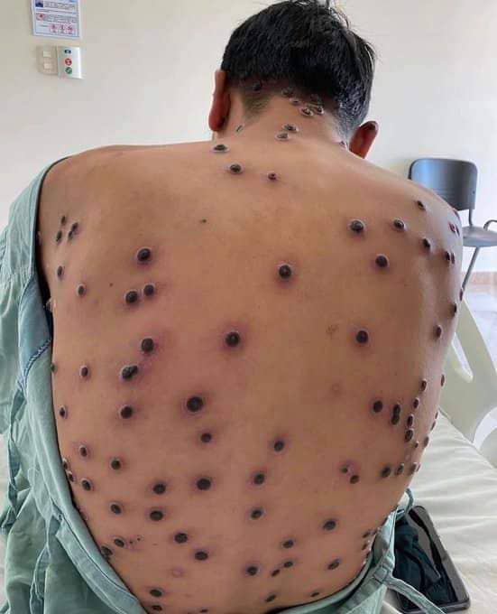 Malaysia Tingkatkan Pengawasan dan Kesedaran Mpox Selepas Amaran Tertinggi WHO